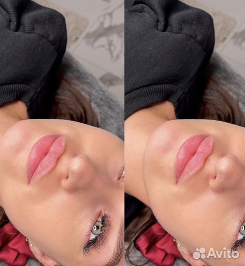 Обучение увеличение губ, ботолутоксин