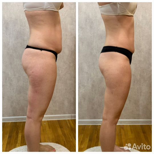 Антицеллюлитный массаж