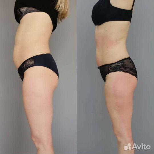 Антицеллюлитный массаж