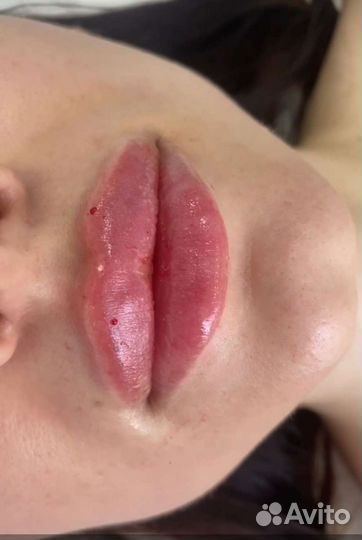 Ультразвуковое омоложение лица