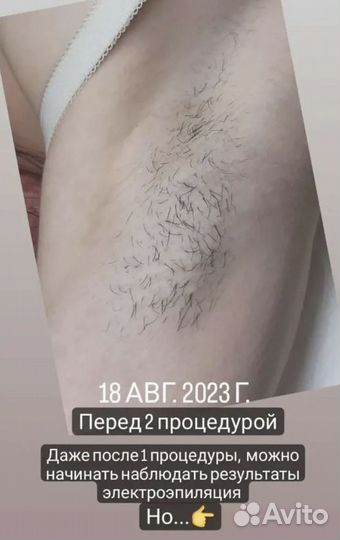 Электроэпиляция модель