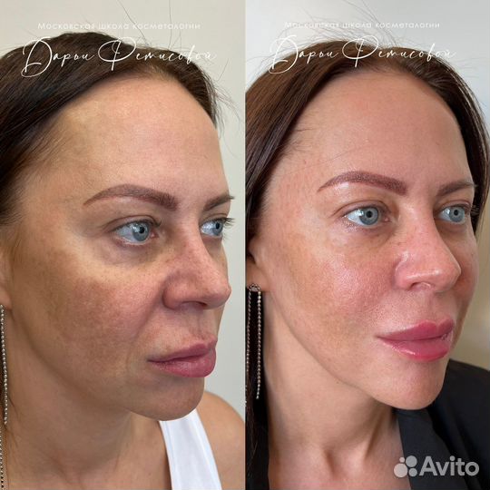 Lumecca фототерапия фотоомоложение