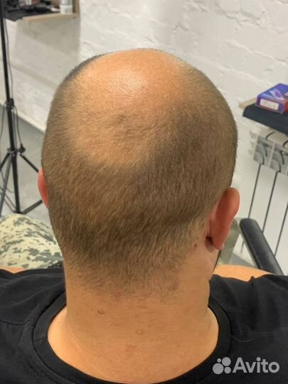 Трихопигментация головы SMP