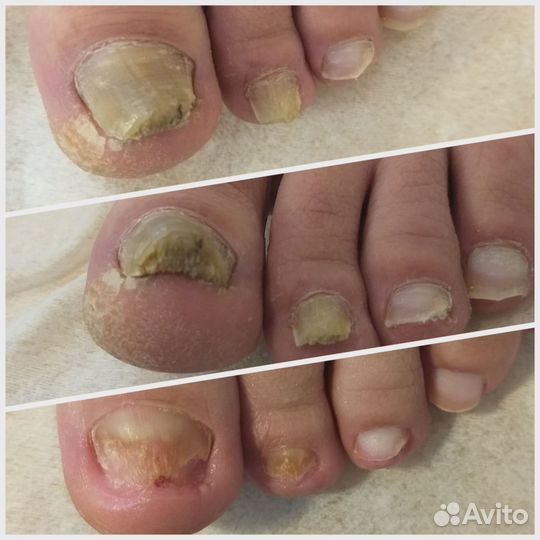 Педикюр / Подолог / Медицинский педикюр