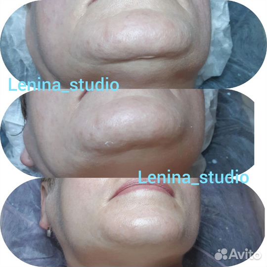 Вакуумный массаж кавитация RFлифтинг коррекция