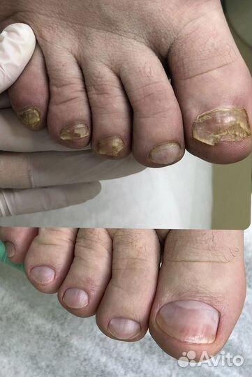 Подолог, вросший ноготь, мозоли