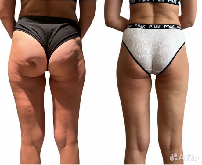 Антицеллюлитный массаж