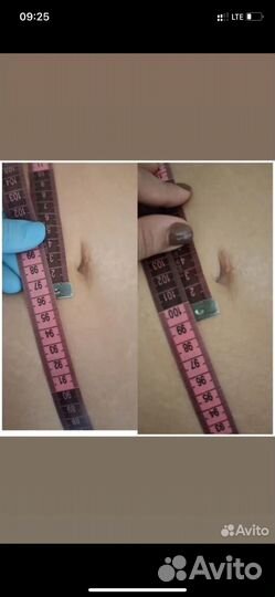 Аппарат Жиротоп