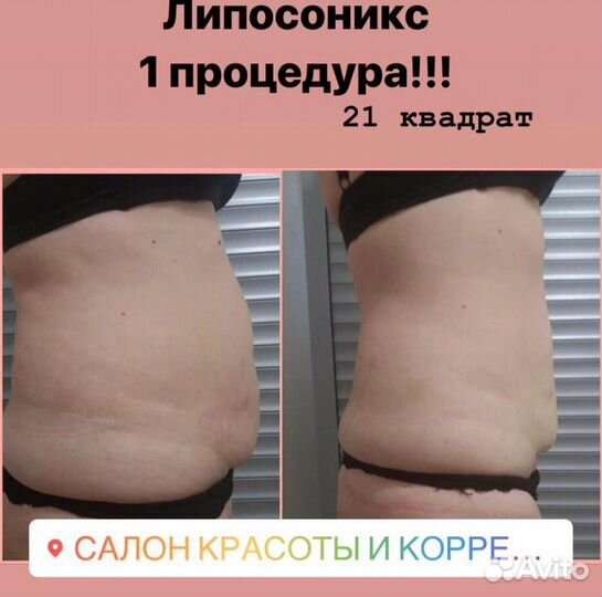 Липосоникс - коррекция фигуры