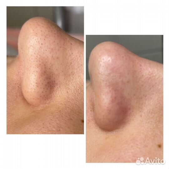 Косметолог, чистка лица, пилинги, хиромассаж