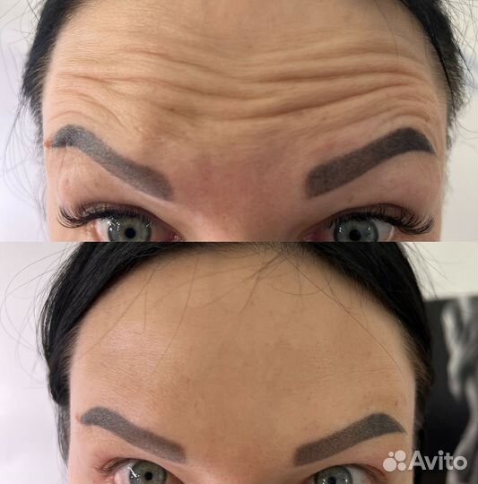 Ботокс для лица