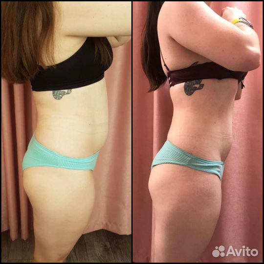 Криолиполиз