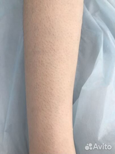 Лазерная эпиляция/Шугаринг/ Воск