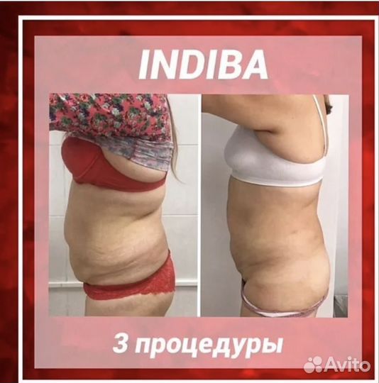 Индиба(Indiba) похудение и омоложения