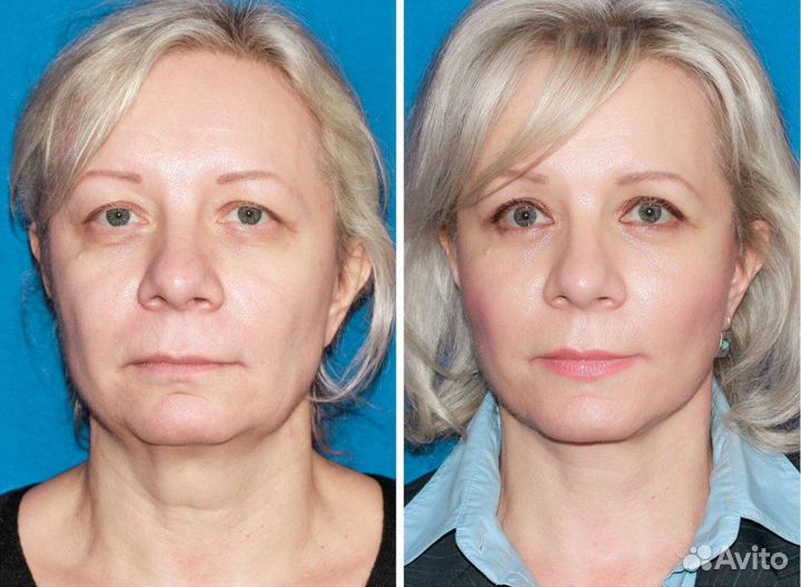 Модели на Кислородное Омоложение Подбородка