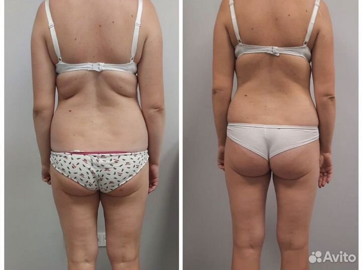 Аппаратный массаж (курс фигура песочные часы)