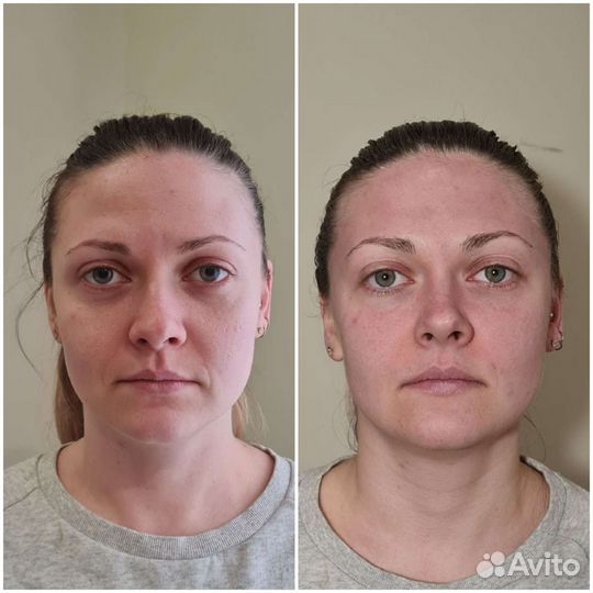 Скульптурно-буккальный массаж лица