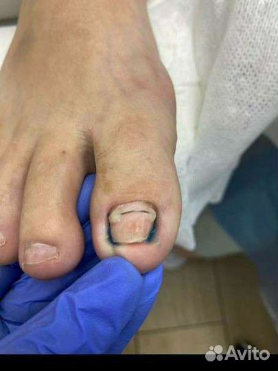 Установка титановой нити, вросший ноготь