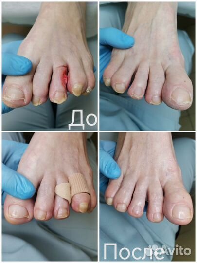 Педикюр подолога