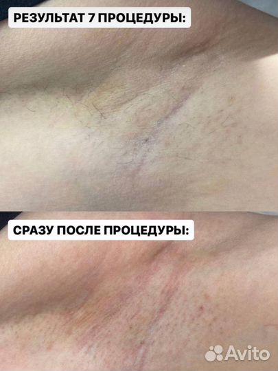 Эпиляция