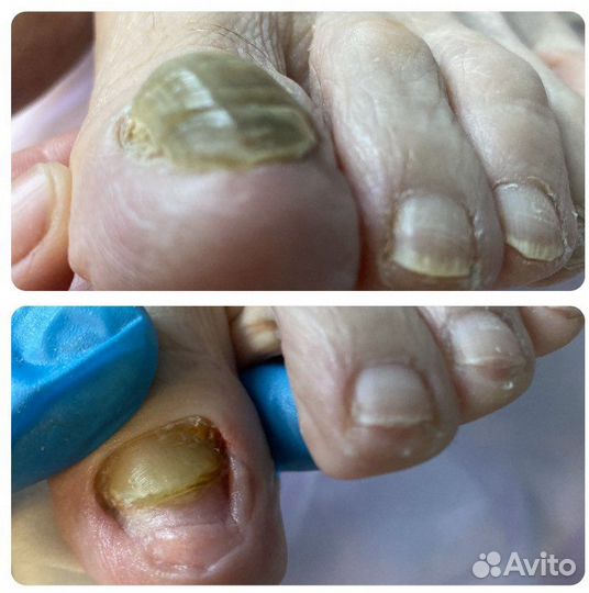 Бородавки.Мозоли.Вросшие ногти.Педикюр.Подолог