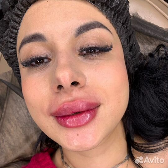 Увеличение губ