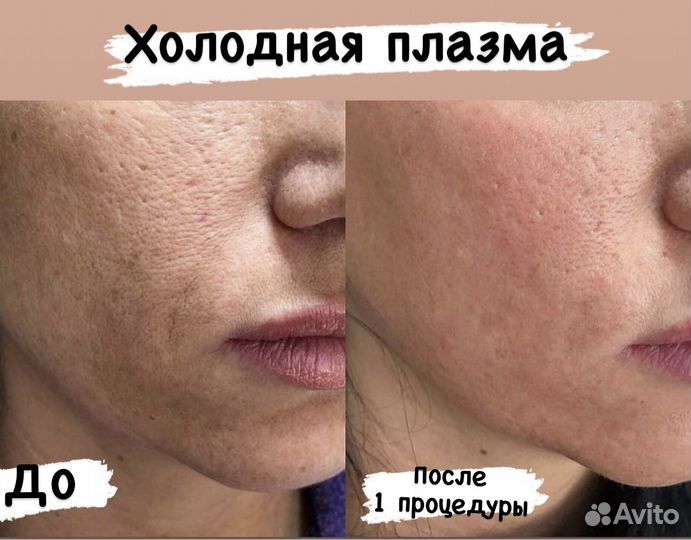 Холодная плазма