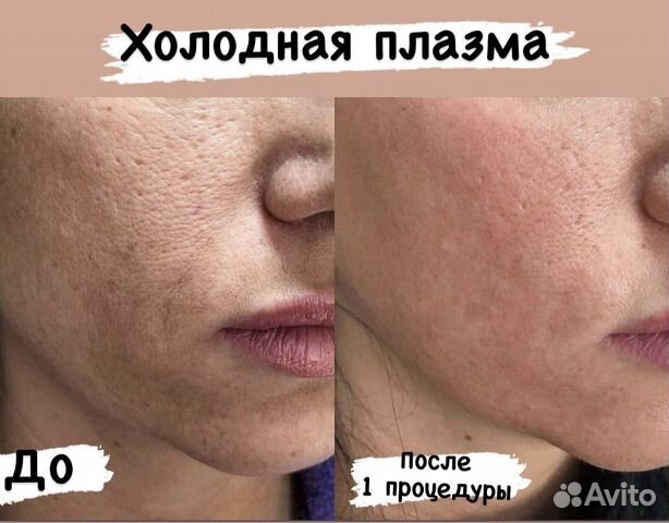 Холодная плазма