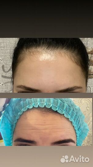 Ботокс.Косметология