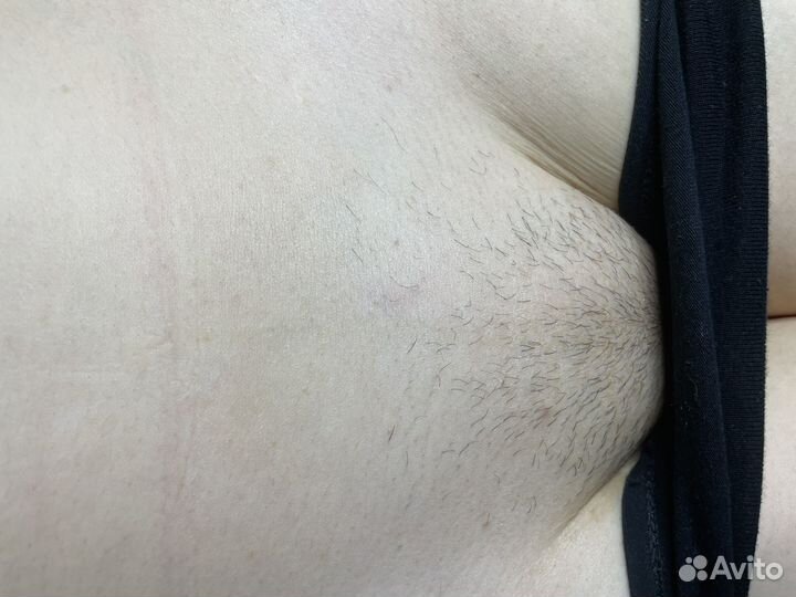 Электроэпиляция юмр