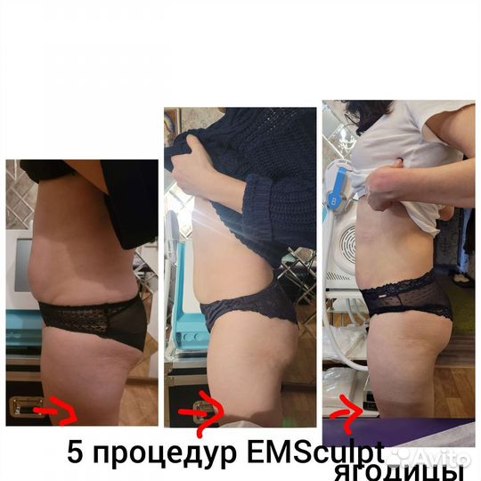 Еmsculpt прокачка мышц, похудение