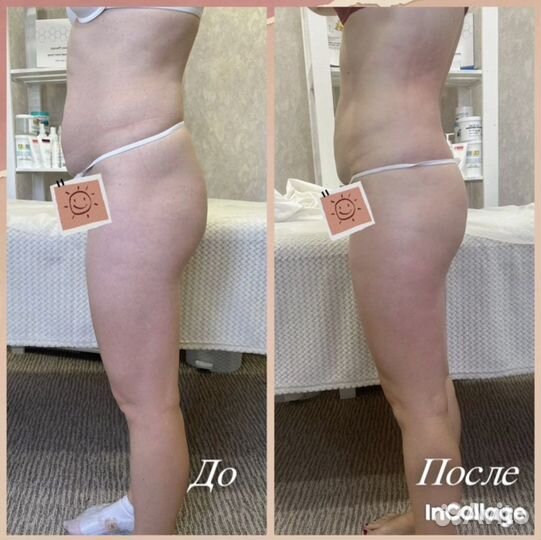 Антицеллюлитный массаж, классический массаж