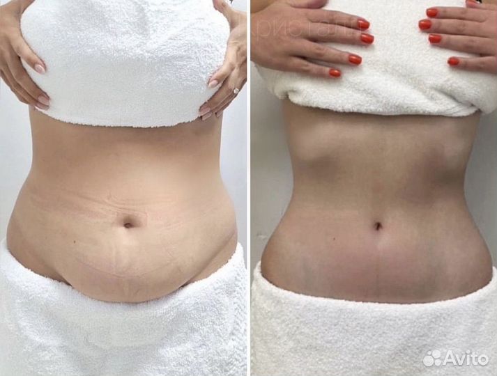 Аппаратная коррекция фигуры