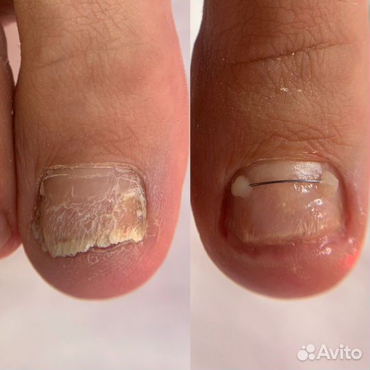 Подолог педикюр