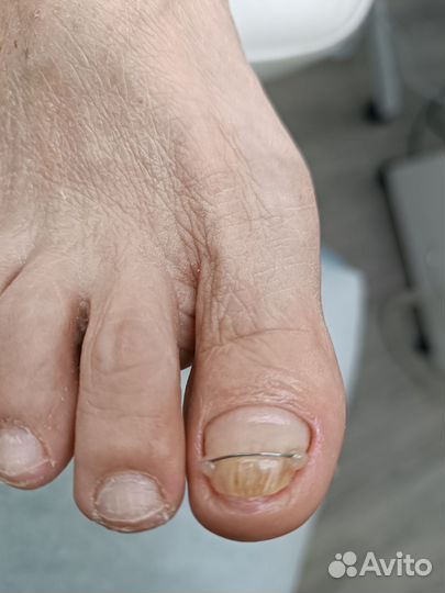 Подологический педикюр