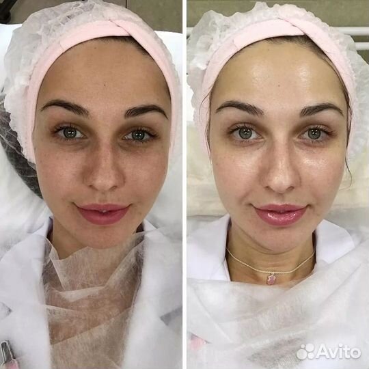 Лифтинг лица