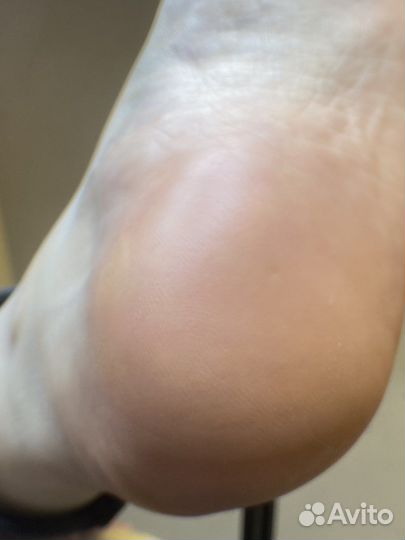 Подолог, установка титановой нити