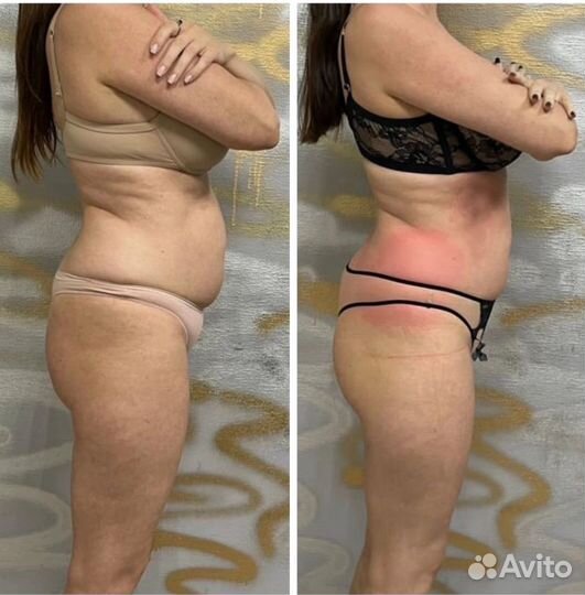 Липоксация без операции