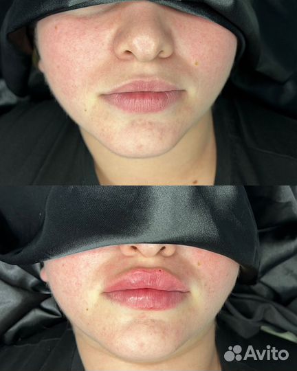 Увеличение губ