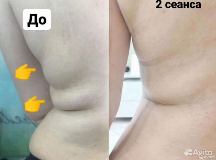 Инъекции ботокса в лоб