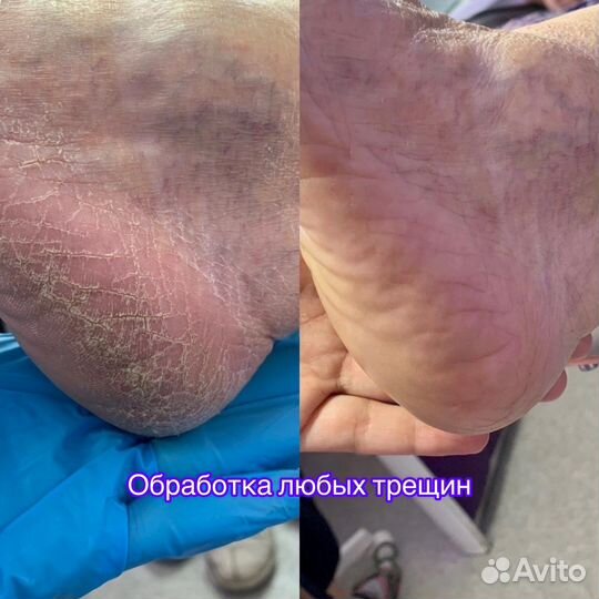 Подолог (вросший ноготь, мозоли, трещины)