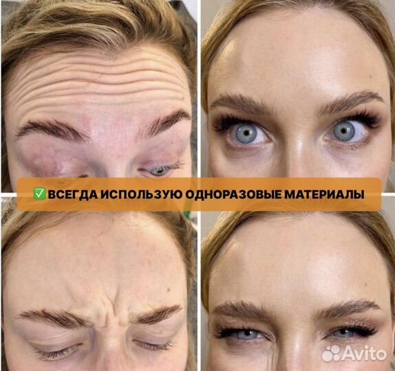 Ботулинотерапия