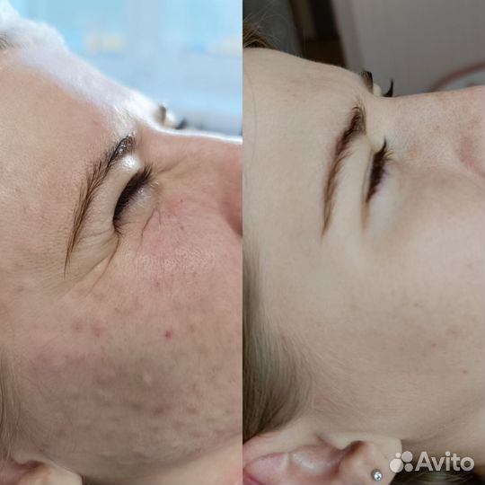 Ботокс лица