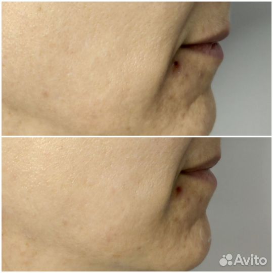 Смас лифтинг / smas лифтинг