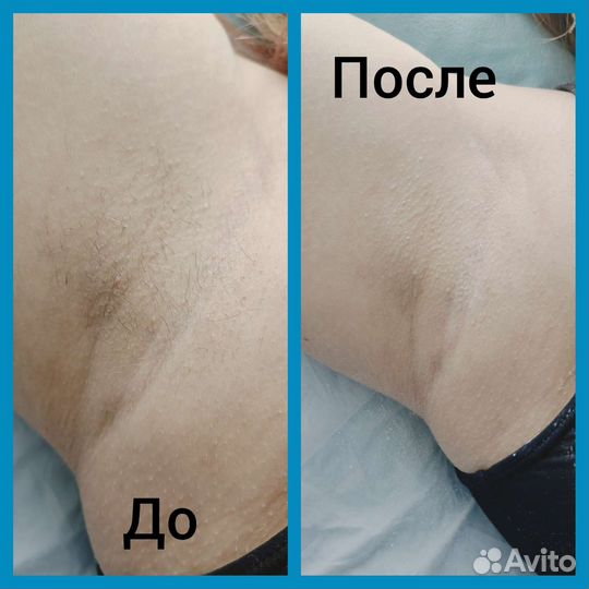 Депиляция воском