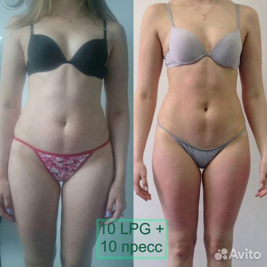 LPG массаж лимфодренажный