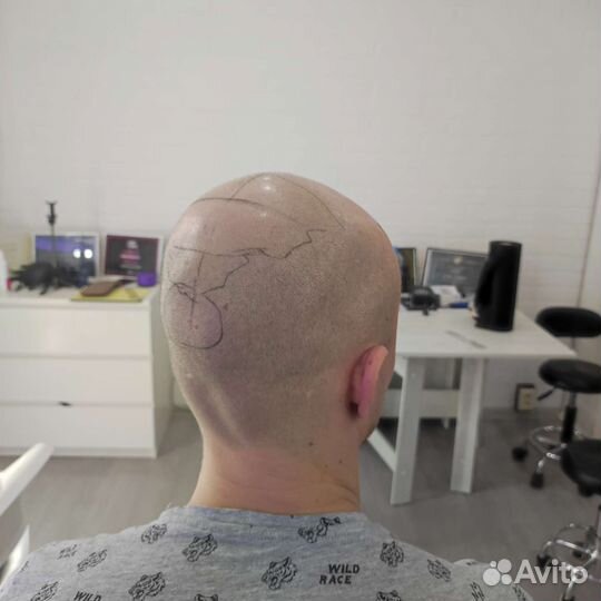 Трихопигментация головы