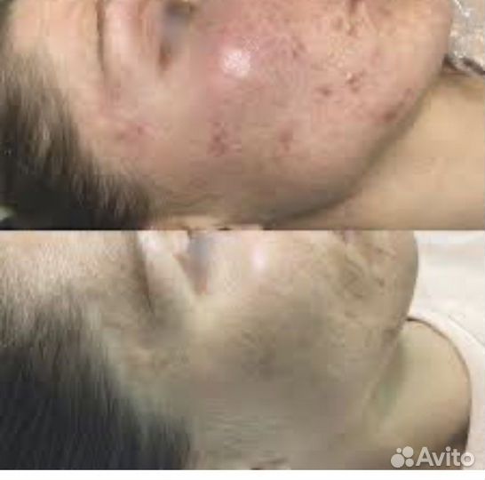 Плазмолифтинг