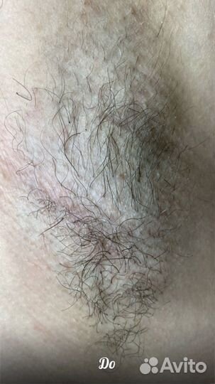 Электроэпиляция