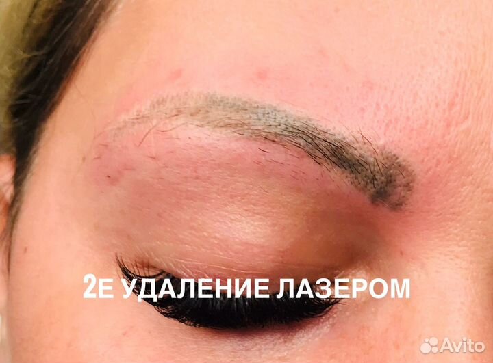 Удаление татуажа, перманентного макияжа, татуирово